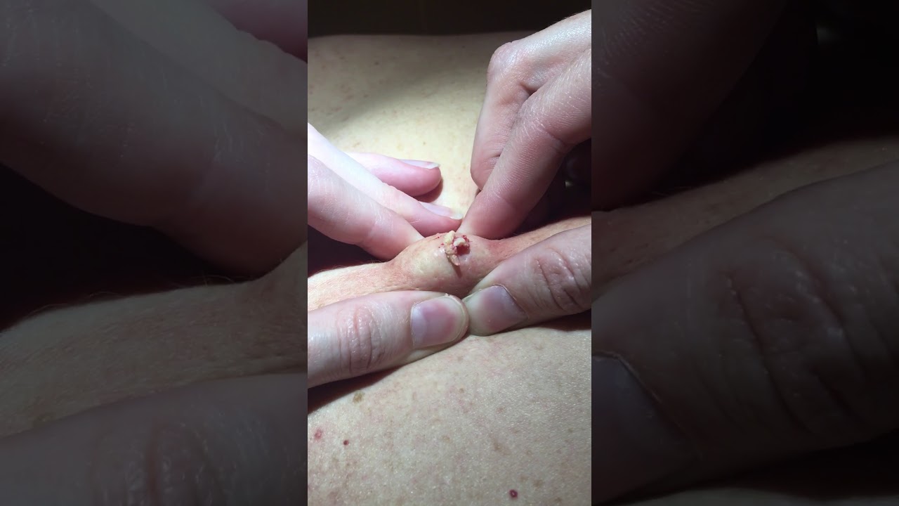 Popping Huge Back Cyst