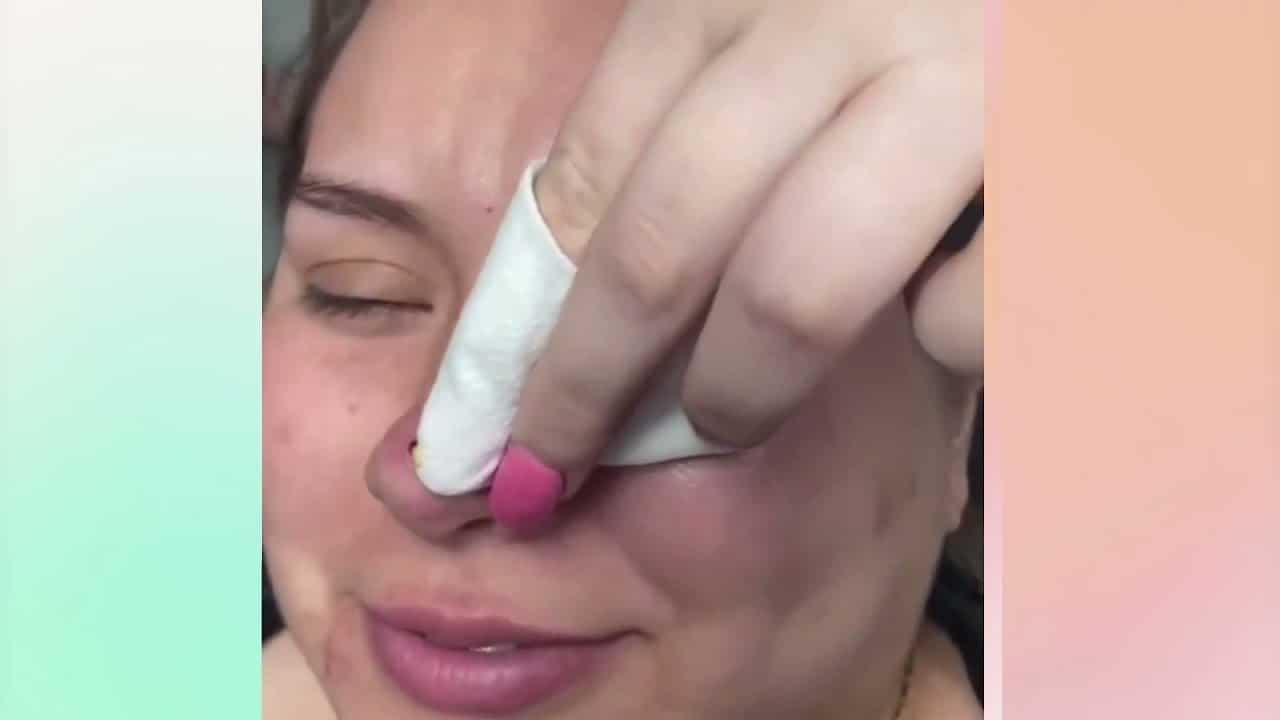 Popping huge blackheads and Pimple Popping   Blackhead Pimples Attractive Videos and Relaxing 03