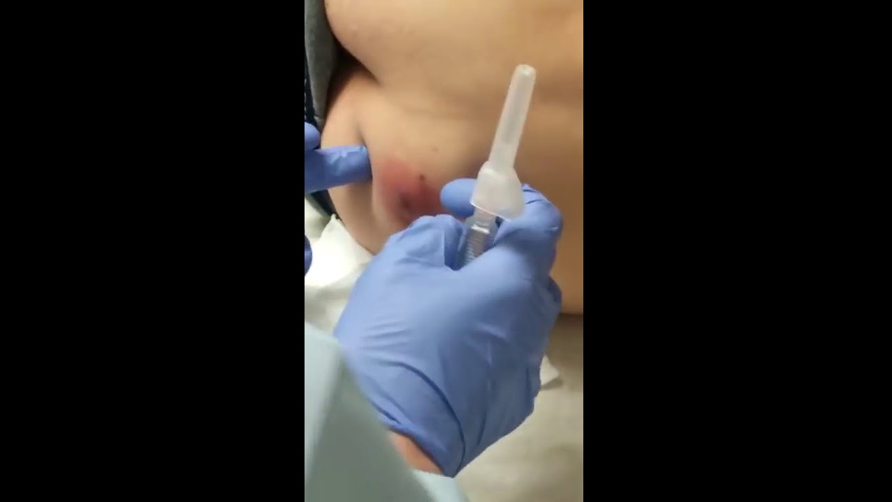 Popping Huge Cyst  Prepare yourself!