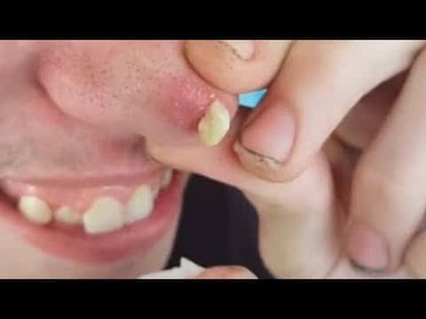 Popping huge pimple and blackheads|| Pimple Haven #15