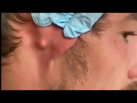 Popping huge pimples, blackheads and cyst videos|| Pimple Haven #17