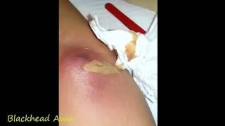 Popping huge sebaceous cyst Cyst Extractions Close Up YouTube cary