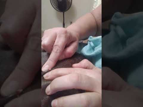 Popping huge zit cyst jimmie nelson
