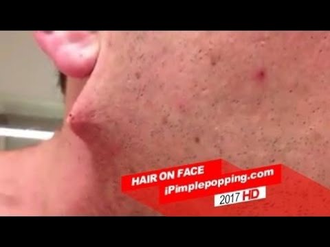 Popping Huge Zit on the back , Pimple popping at home | YOUTUBE 2017