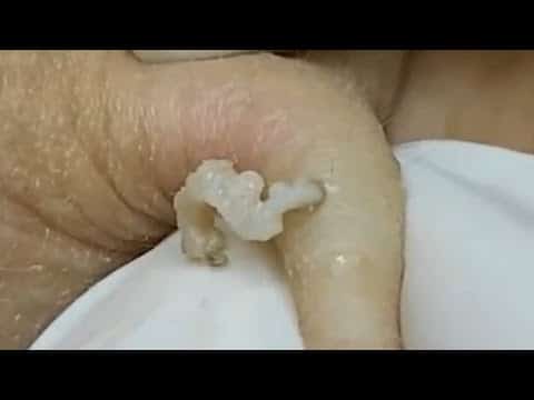 Popping large pimples extraction around eye newest 2021,newest pimple popping video 2021