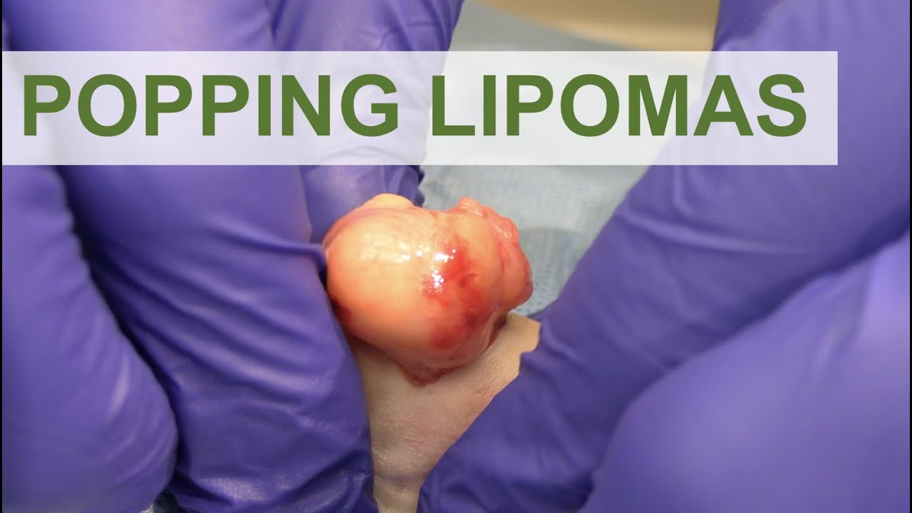 Popping Lipomas | Dr. Derm