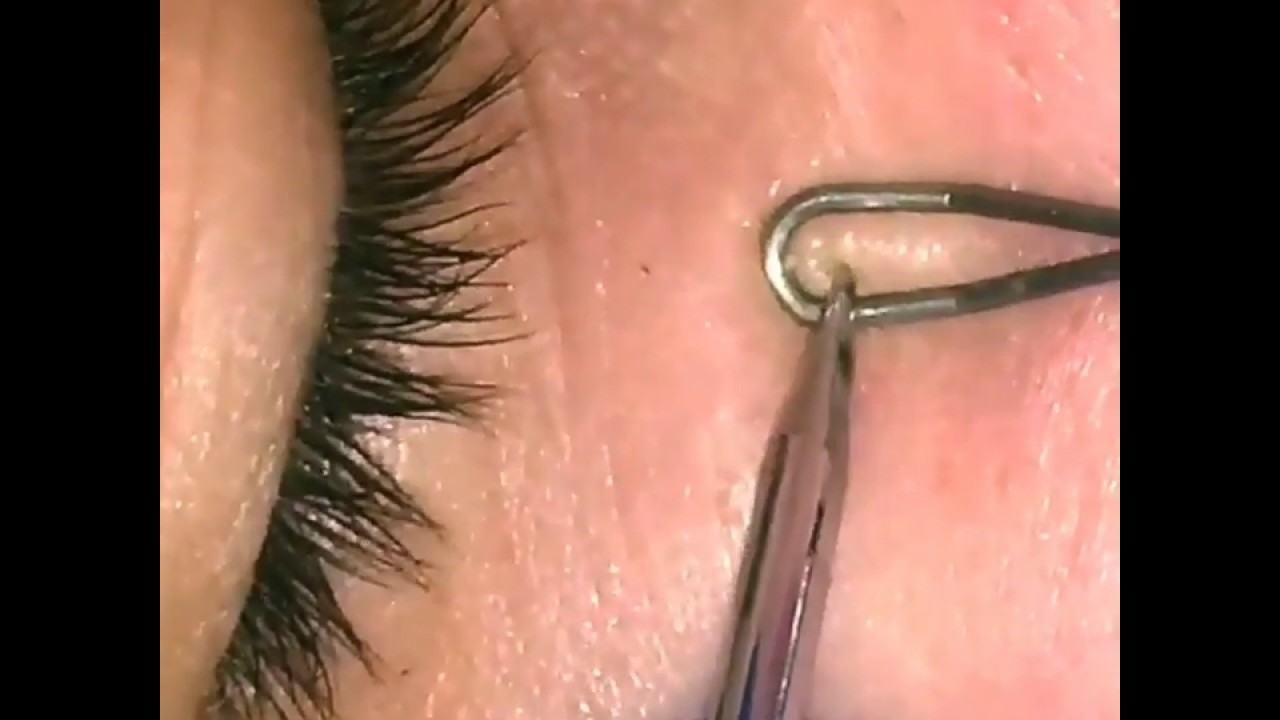 Popping Milia cyst extraction under the eyes! Dr. U.K.M.D