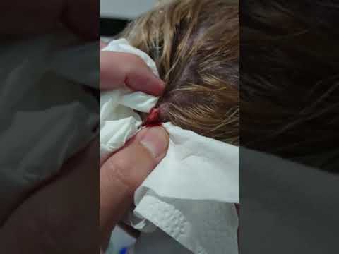 Popping my sebaceous cyst – pimple popping