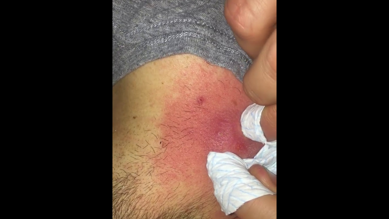 Popping neck cyst
