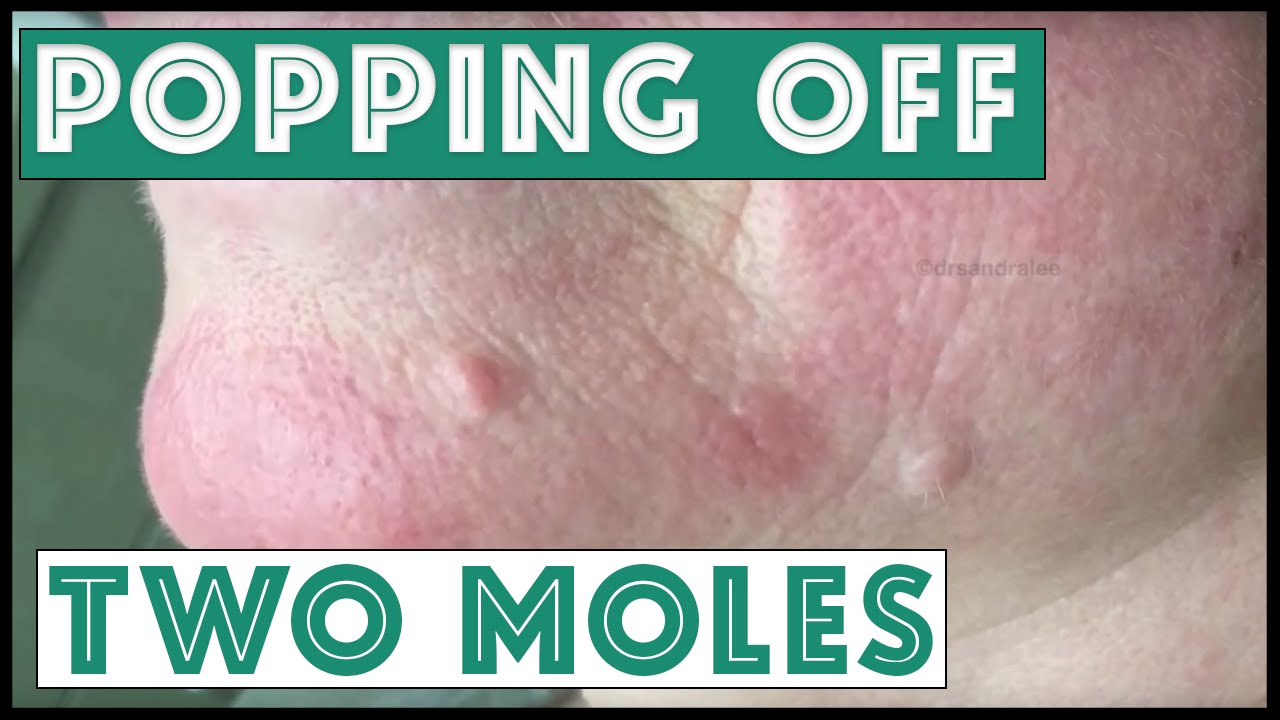 “Popping” off two moles on the face. For medical education- NSFE