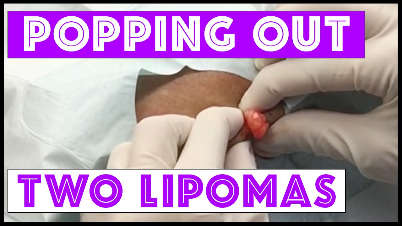 Popping out 2 lipomas on the arm