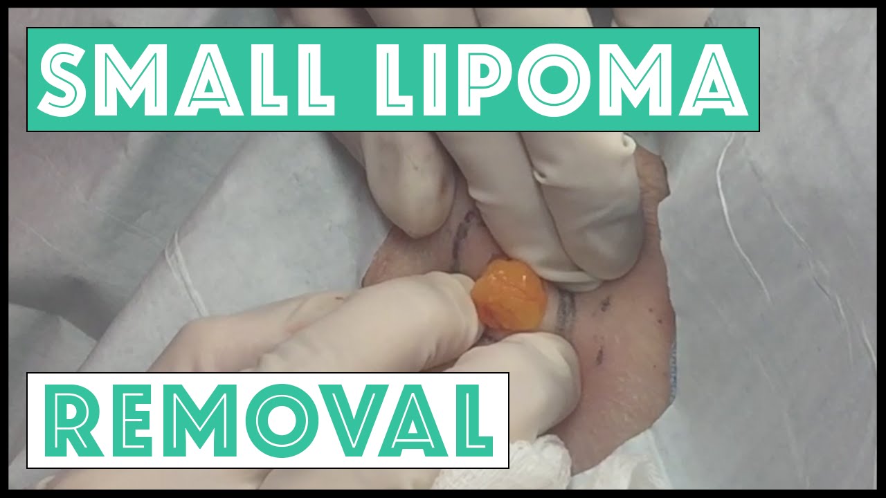 Popping out a PEACH of a Lipoma on the Right Upper Arm