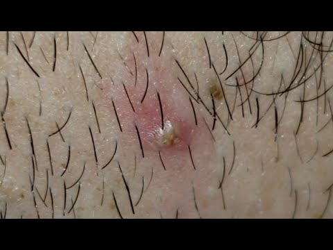 Popping Pimples on Neck and Back ASMR Pulling Ingrown Hairs Satisfying Plucking