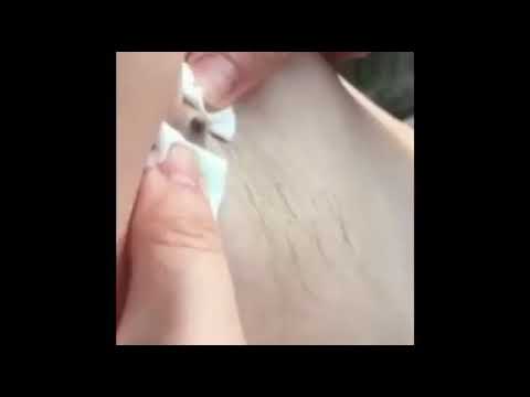POPPING THE BIG BLACKHEADS IN THE UNDERARM(part 1)