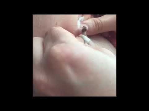 POPPING THE BIG BLACKHEADS IN THE UNDERARM (PART 2)