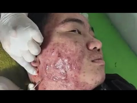 Popping the largest cyst