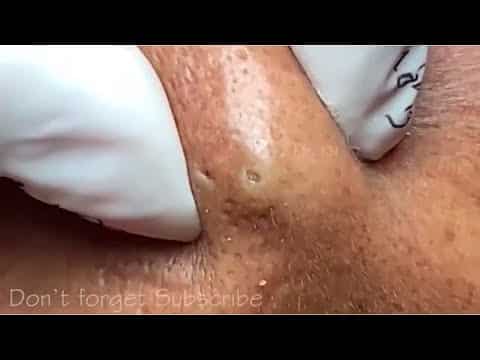 Popping the top 3 biggest cyst | Massive Abscess removal