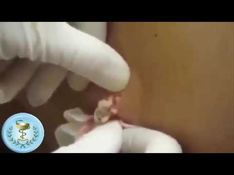 Popping the worlds largest pimple