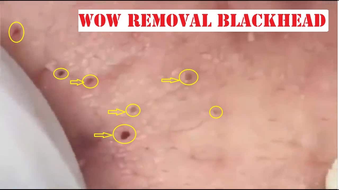 Popping Tons Of Blackheads Part 14