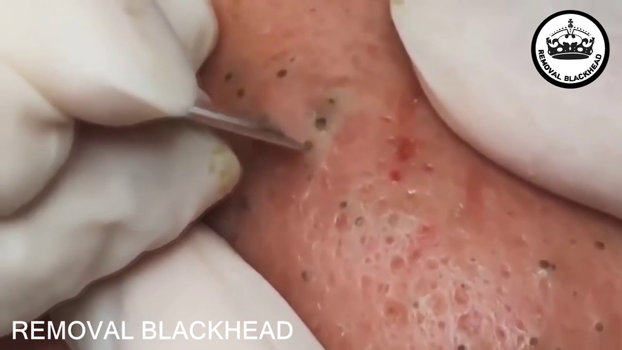 Popping Tons Of Blackheads Part 09