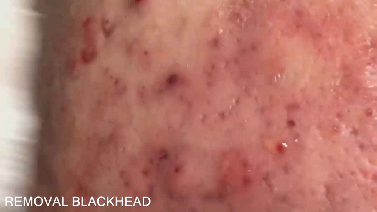 Popping Tons Of Blackheads Part 06