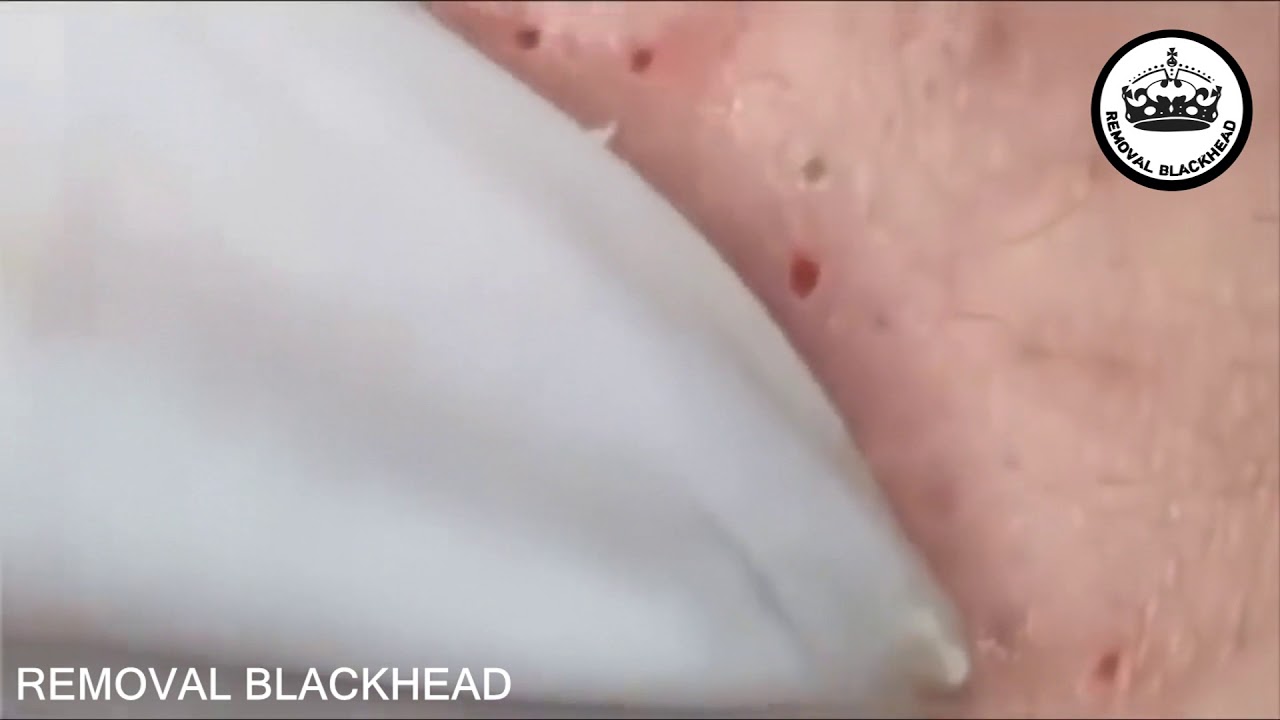 Popping Tons Of Blackheads Part 14
