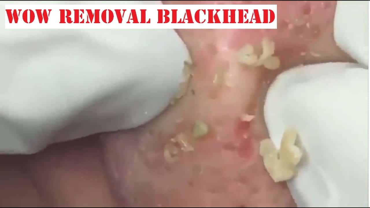 Popping Tons Of Blackheads Part 15