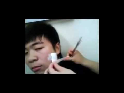 Popping zit in Eyes l Removing a huge blackhead l pimple popping 2016 l By Amazing pimple popper