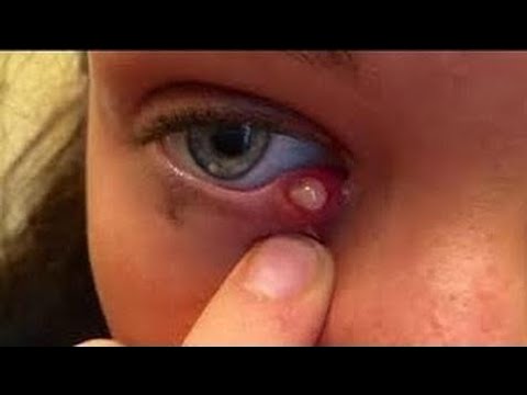 Popping zit in Eyes l Removing a huge blackhead l pimple popping 2017 l The best pimple popping