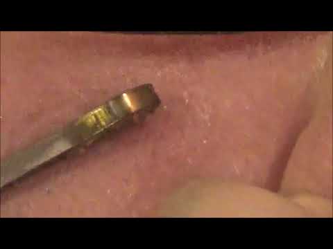 Popping Zits With A Bobby Pin