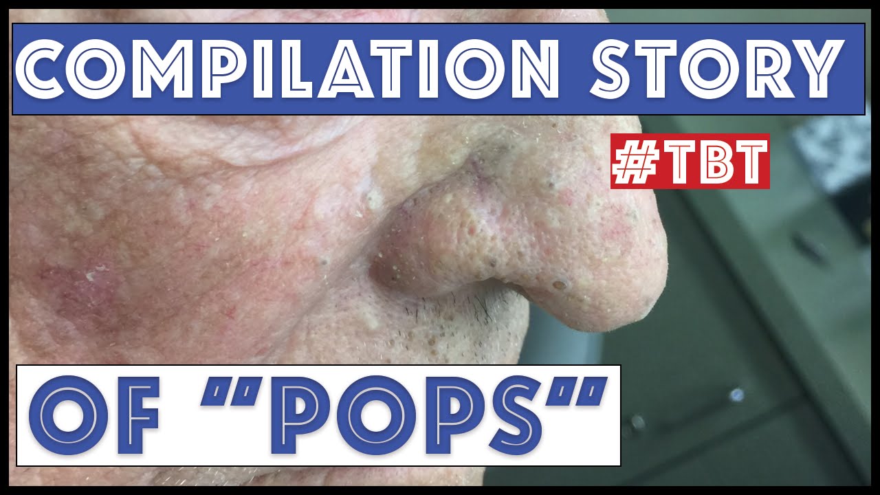 "Pops" and his BEST blackhead extractions – TBT