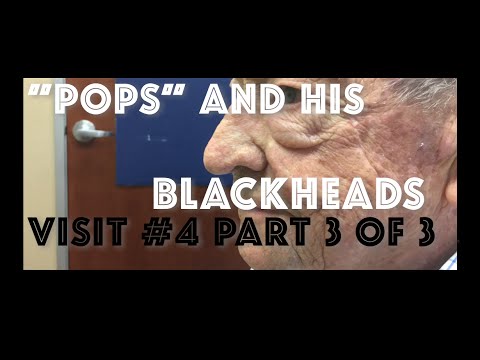 “Pops” and his blackhead extractions: Visit #5 including skin biopsy