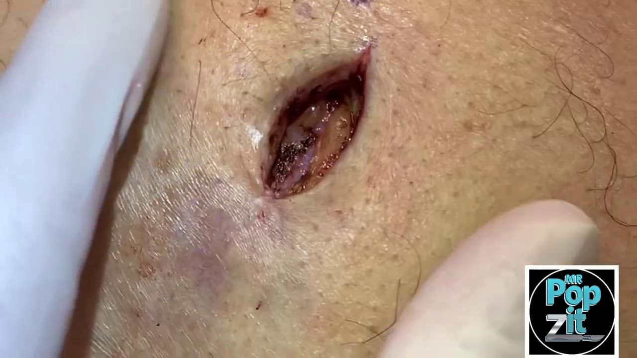 Post Antibiotic Inflamed cyst sinus tract removal. Excision of remaining cyst contents post pop.