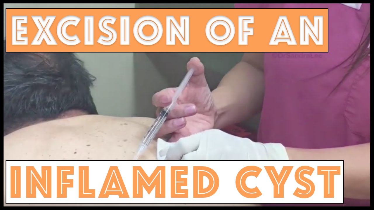 Previously inflamed cyst, excised completely. For medical education- NSFE. Warning- graphic