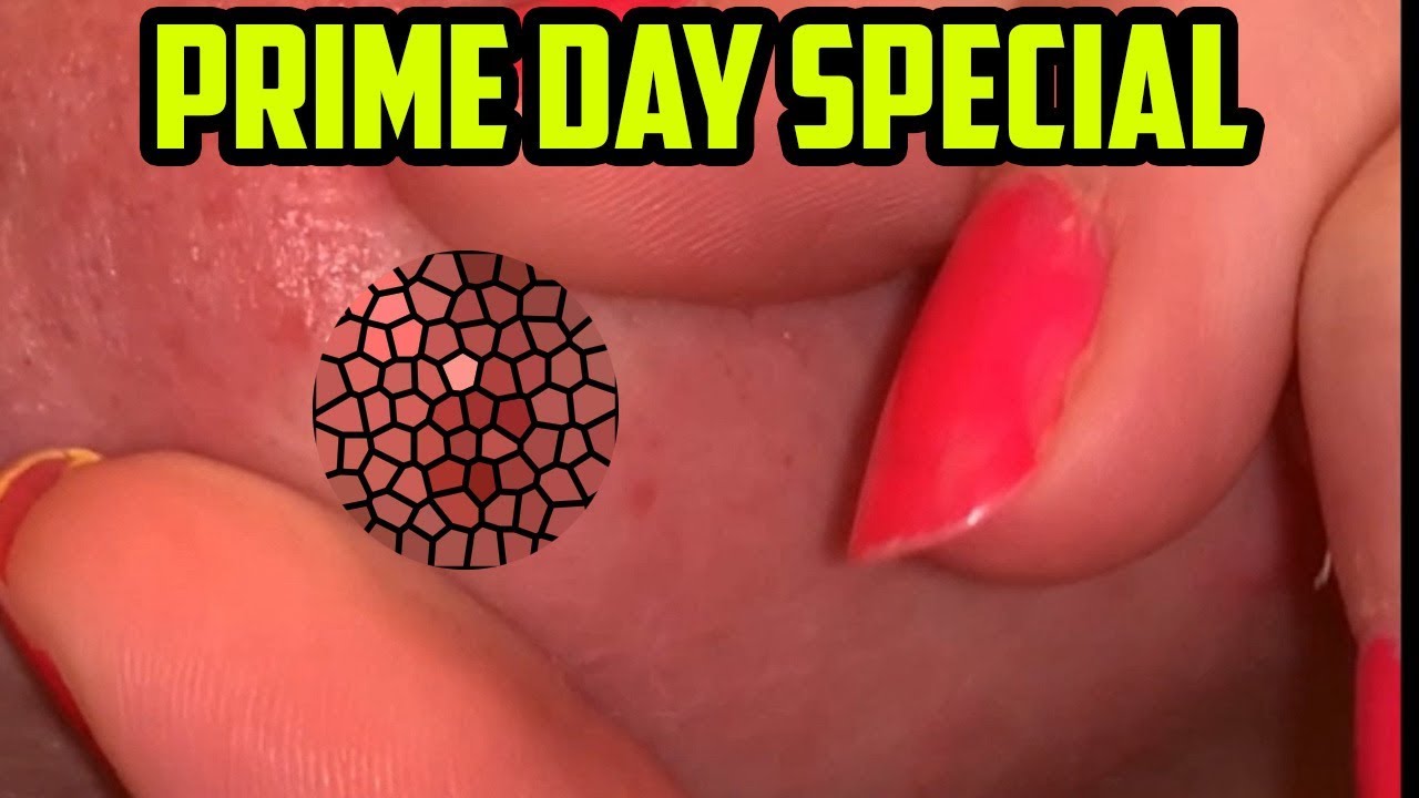 Prime Day Pimple Popping!  Blackheads and Zits