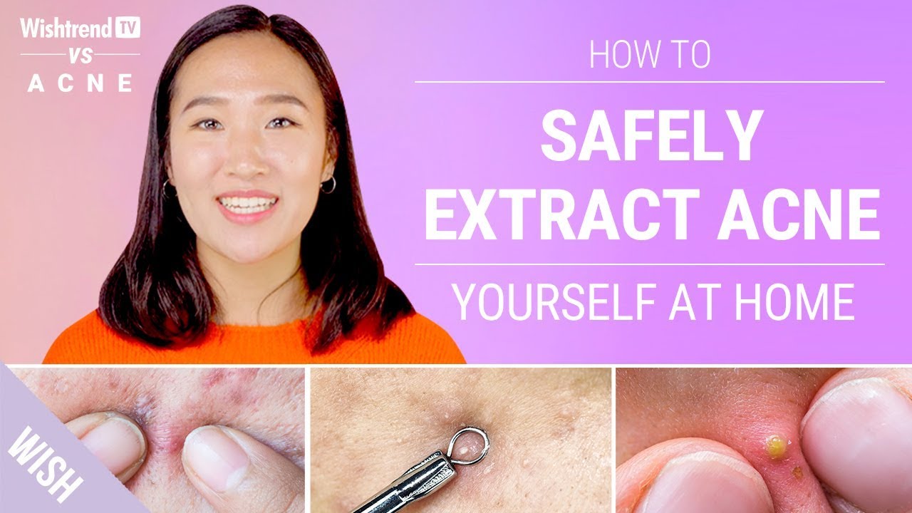 Proper Acne Extraction Steps Without Leaving a Scar! | Wishtrend TV vs ACNE (Feat. Beauty Within)