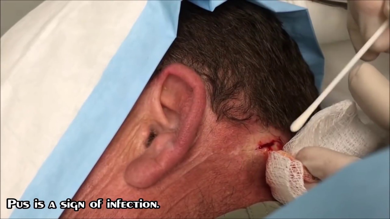 Pudding Cyst!  Diabetic Neck Cyst Popping