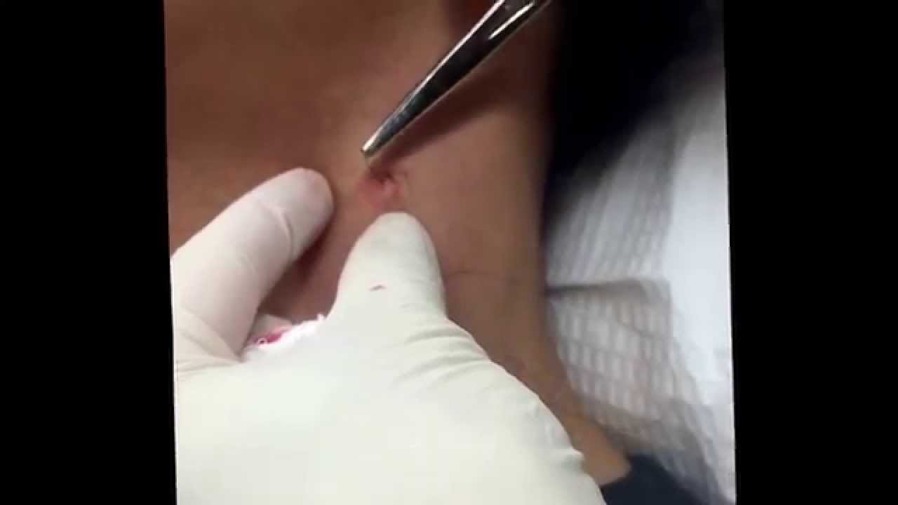 Punch excision of a blackhead on the neck. For medical education- NSFE.