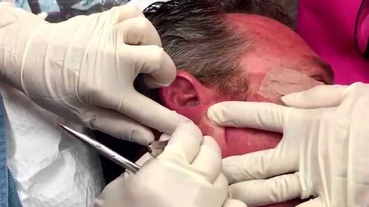 Punch of an epidermoid cyst behind the ear. For medical education- NSFE.