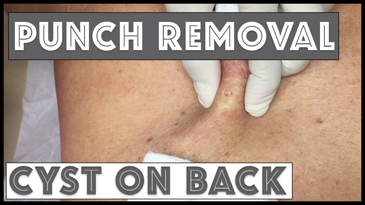Punch removal of a Cyst on back