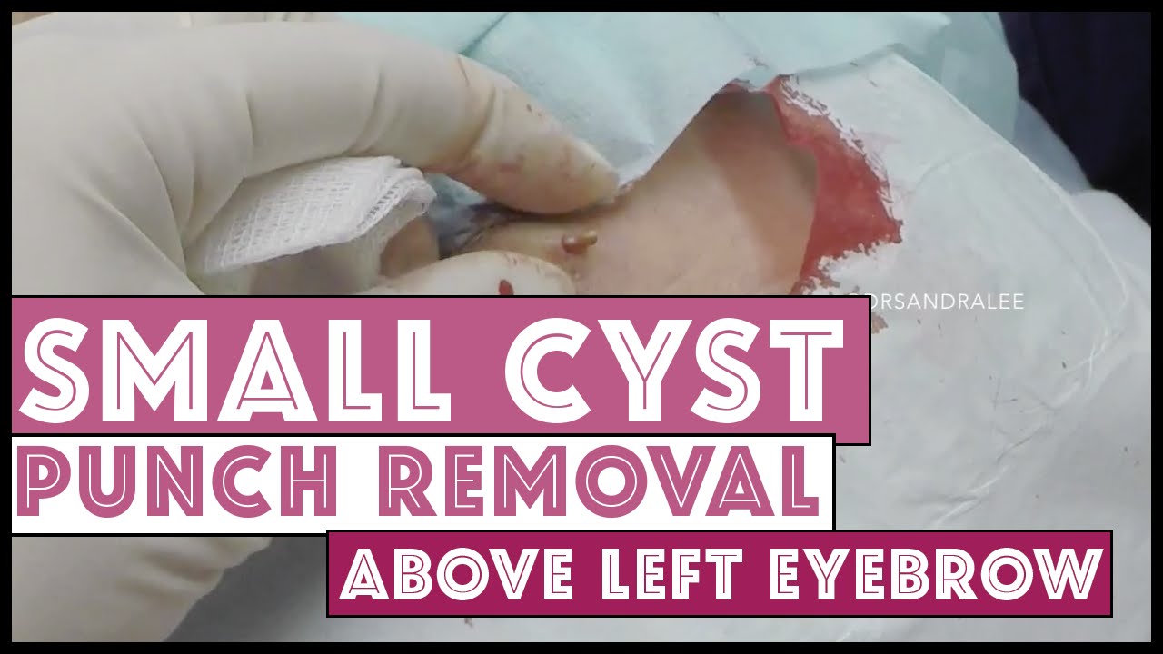 Punch removal of a small cyst, filmed with my GoPro