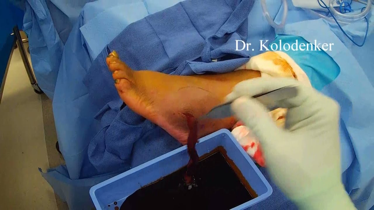 Pus Abscess in the Foot Drained – Video has lots of Pus