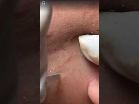 Pus and whiteheads coming out face/ Pimple popping/ Blackheads removal
