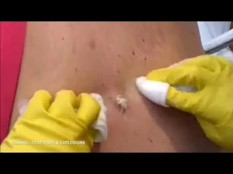 Pus filled blackheads gets squeezed 2016 Pimple popping