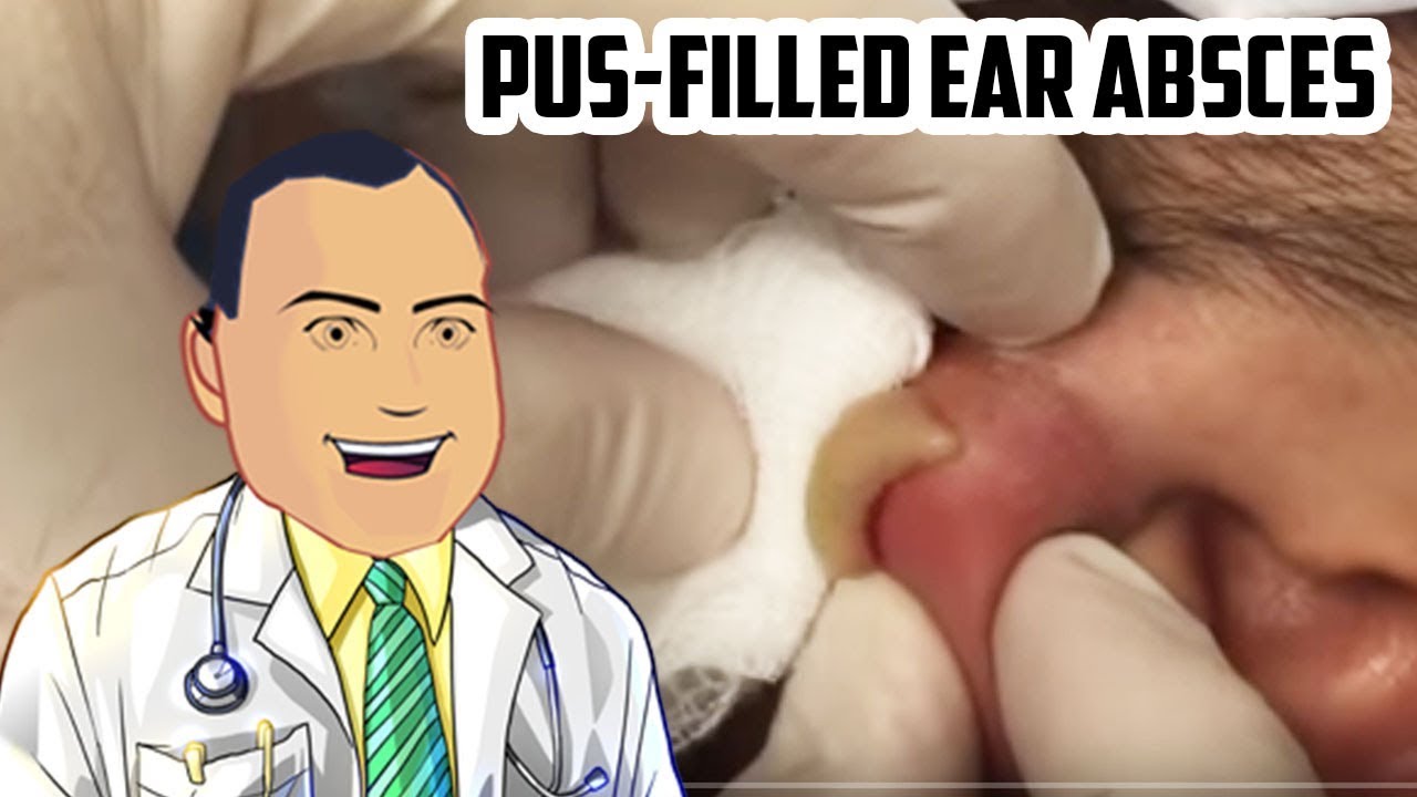 Pus-Filled Ear Abscess Drained – Revisited Popping