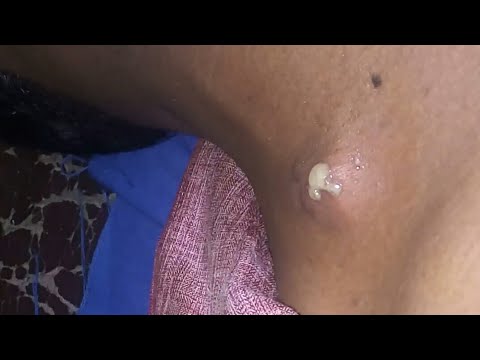 Pus popping from 10 years old cyst