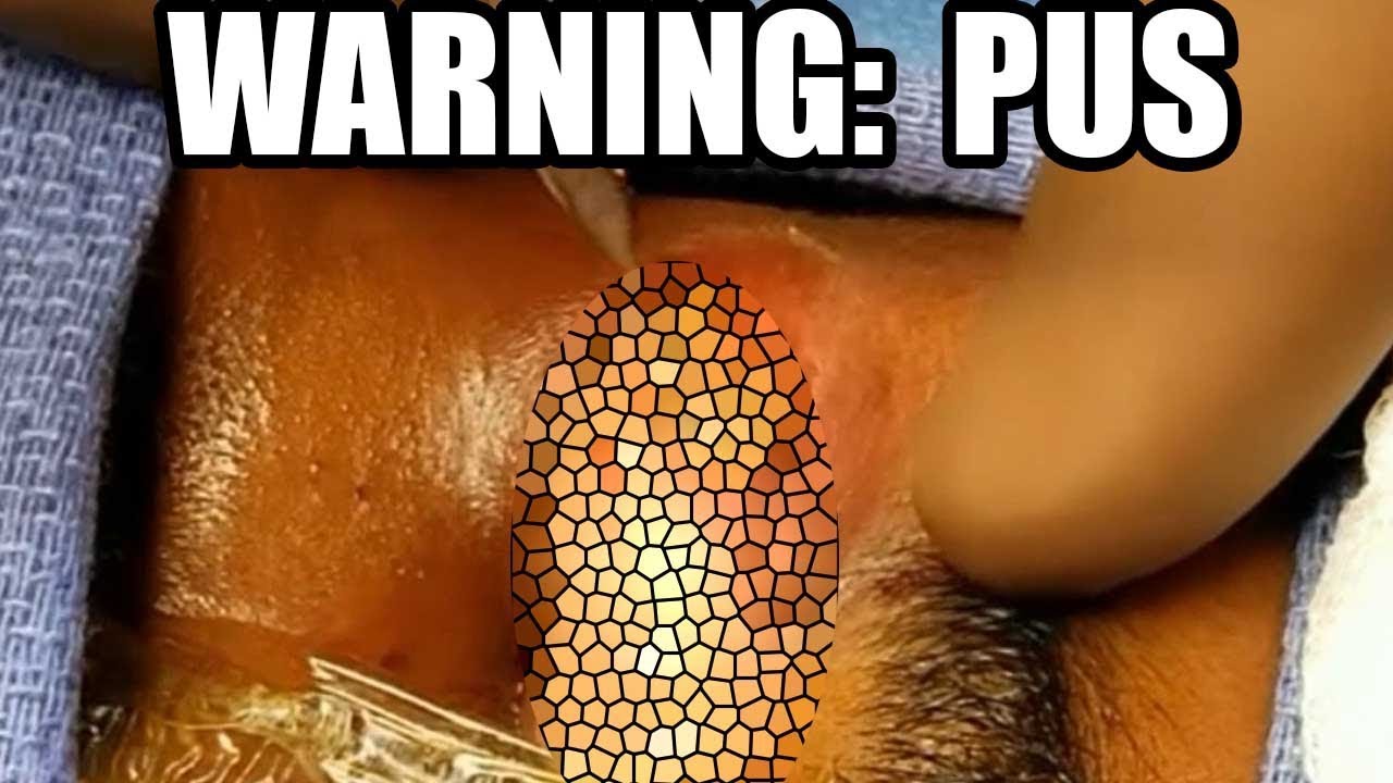 Pus!  What is it?  Abscess, Infections and Pimple Popping