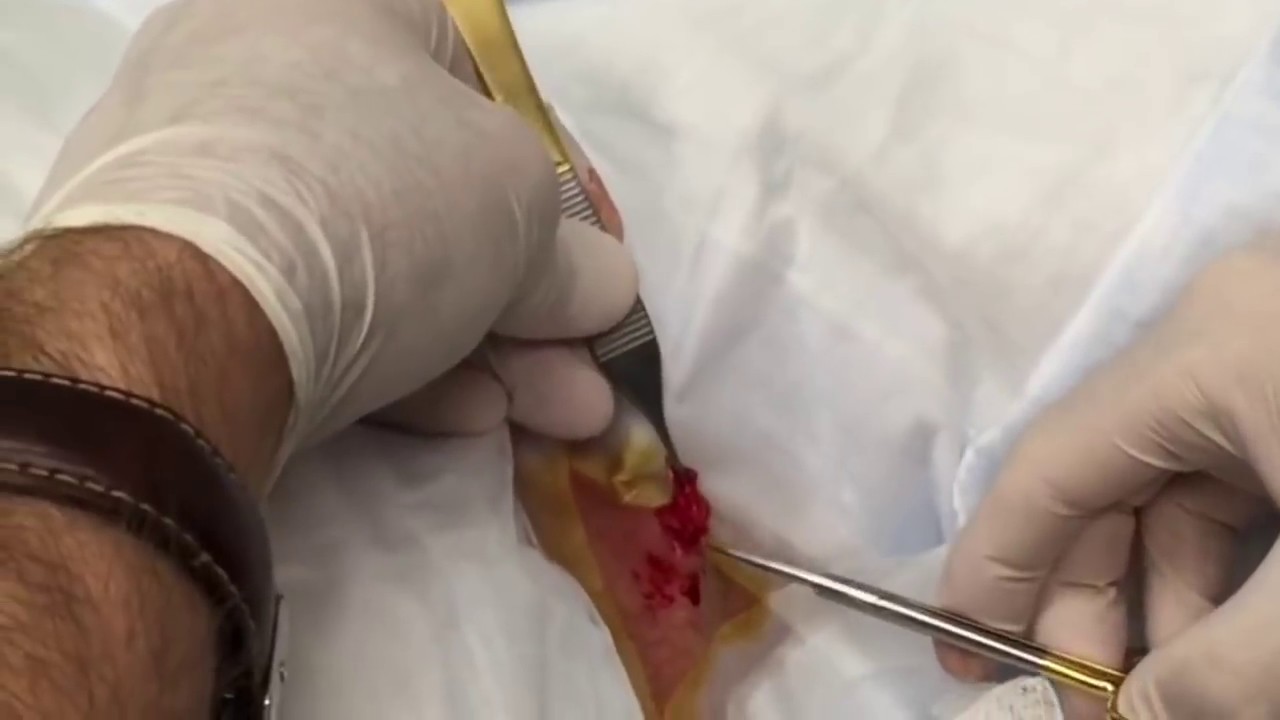 Putrid Neck Cyst Removal Part Two ???