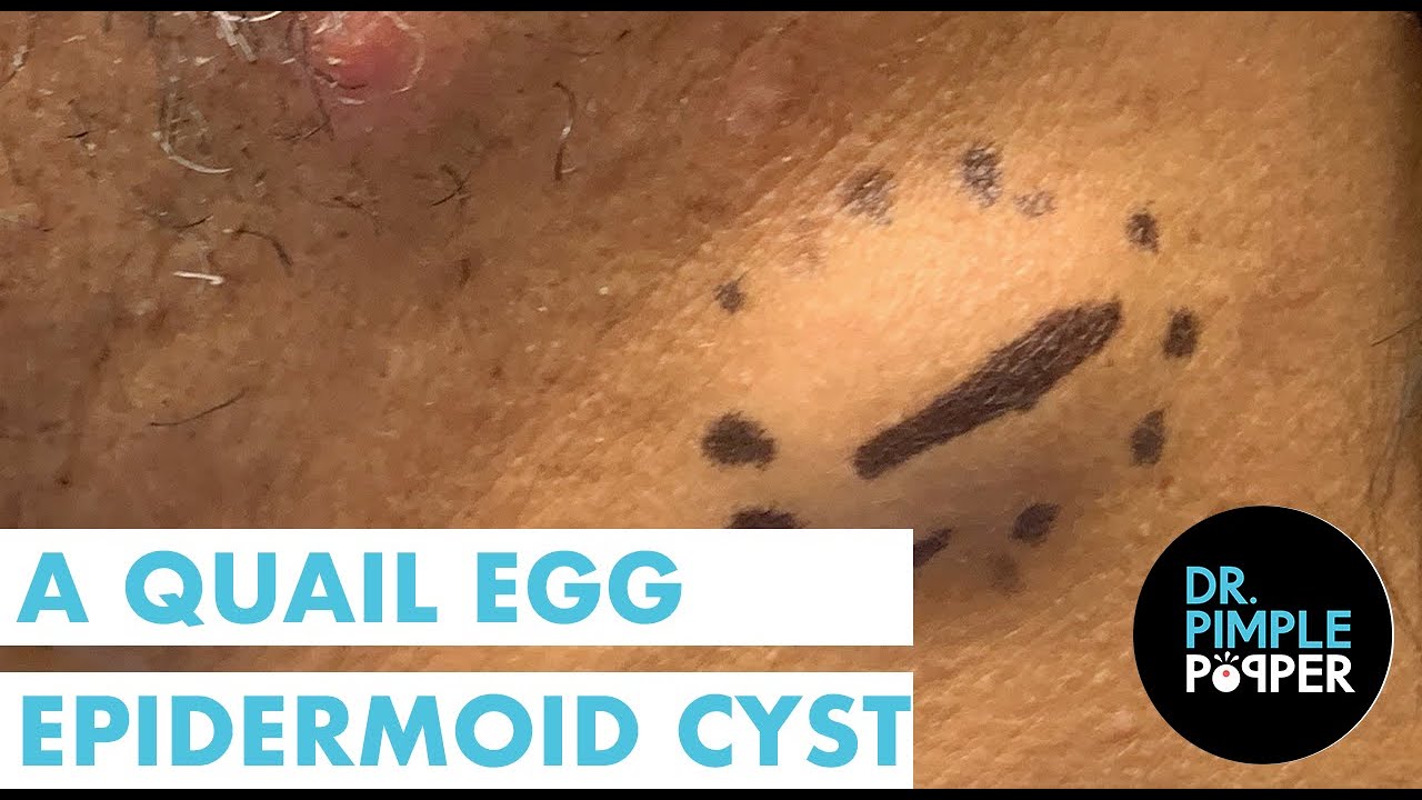 Quail Egg Epidermoid Cyst