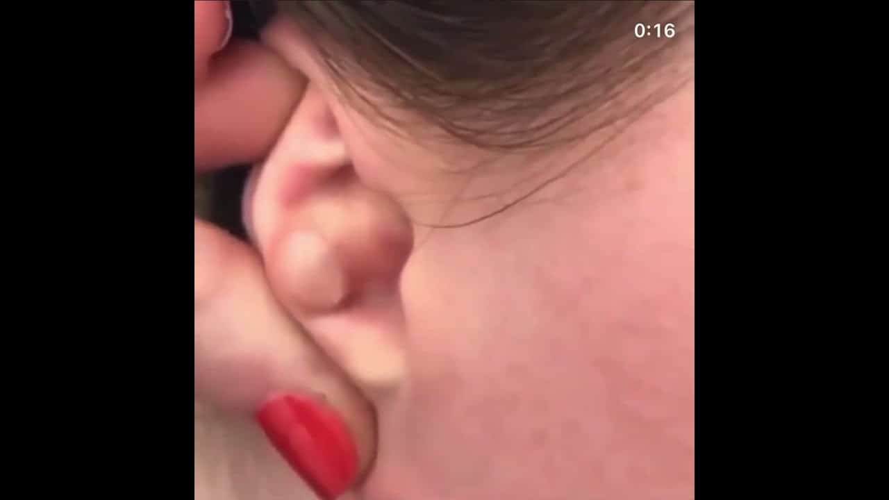 Quick Cyst Popping Fun